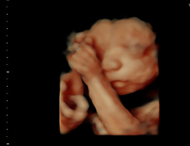 3D ultrasound image at 25 weeks